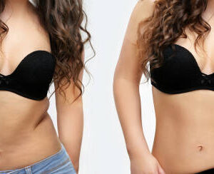 plastic-surgery-for-effect-of-burn-1