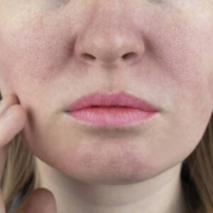 treating-large-pores-10