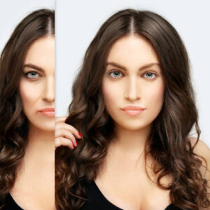eyelid-xanthelasma-removal-2 eyelid-xanthelasma-removal-2