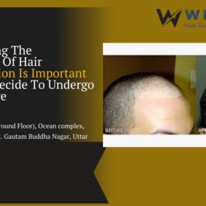 understanding-the-effectiveness-of-hair-transplantation-is-important-before-you-decide-to-undergo-the-procedure