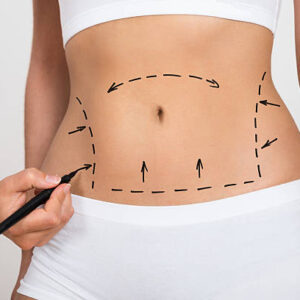 lipo-surgery