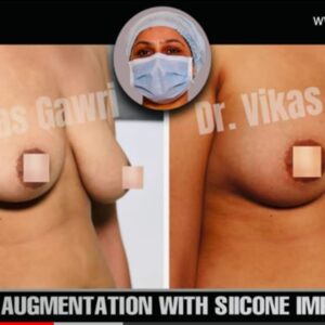 breast-implant breast-implant