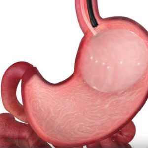 gastric-balloon-surgery1