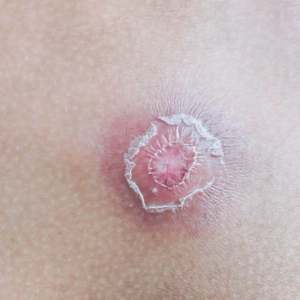 skin-abscess-in-children-signs-causes-treatment-and-home-care1-1-jpg