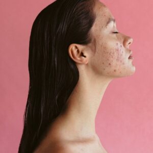 understanding-the-role-of-benzoyl-peroxide-in-acne-management understanding-the-role-of-benzoyl-peroxide-in-acne-management