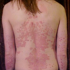 psoriasis2