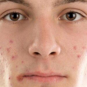 acne-1170x797x0x20x1170x755x1671935312 acne-1170x797x0x20x1170x755x1671935312