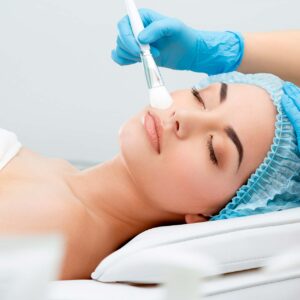 chemical-peels-1