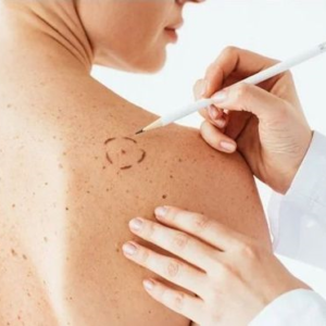 skin-tag-removal-treatment-20