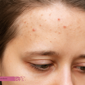acne-vs-pimples-the-difference acne-vs-pimples-the-difference