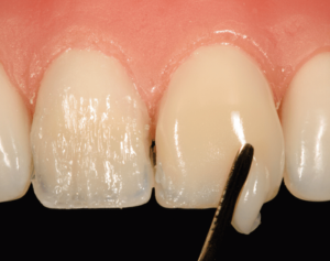 direct-composite-veneers-dental-tourism direct-composite-veneers-dental-tourism