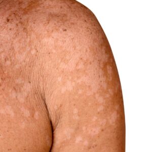 fungal-skin-infections-treatment fungal-skin-infections-treatment