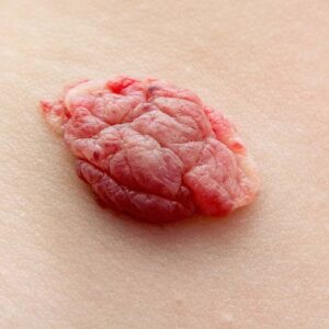 hemangiomas hemangiomas