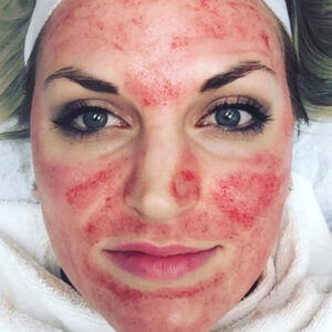 thervo-vampire-facial-closeup-during-procedure thervo-vampire-facial-closeup-during-procedure
