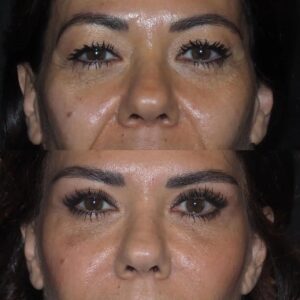 v-upper-eyelid3 v-upper-eyelid3