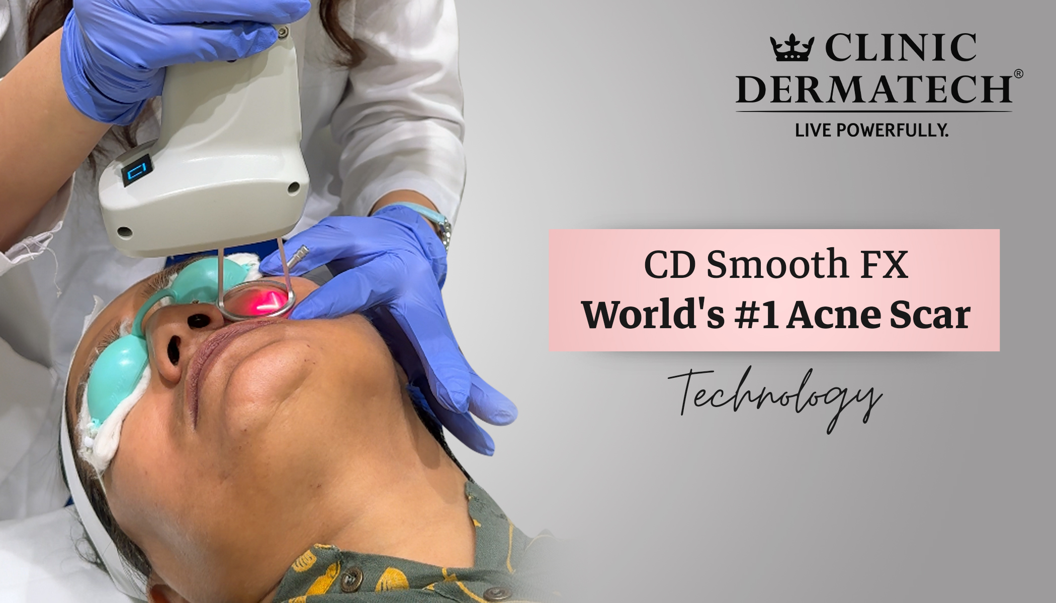cd-smooth-fx-worlds-1-acne-scar-technology